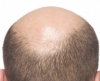 AGA（男性型脱毛症）の治し方まとめ