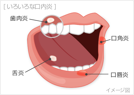 矯正器具による口内炎の原因と特徴